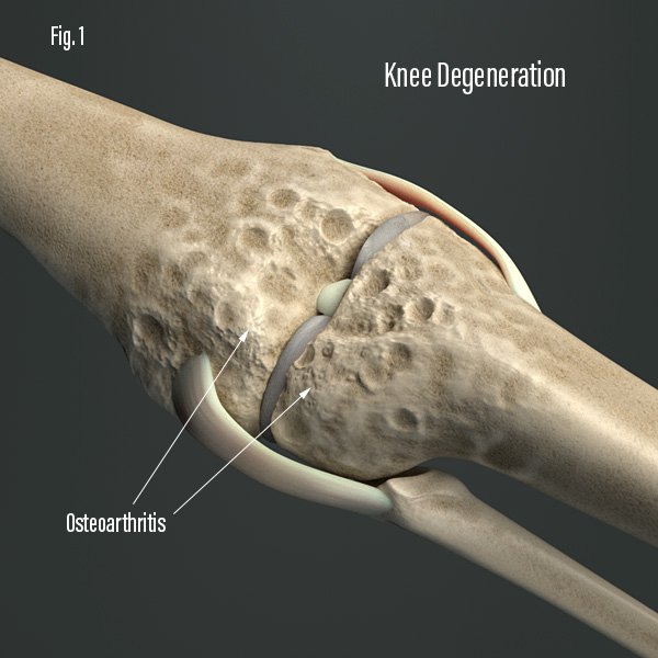 Knee Decompression Treats Osteoarthritis