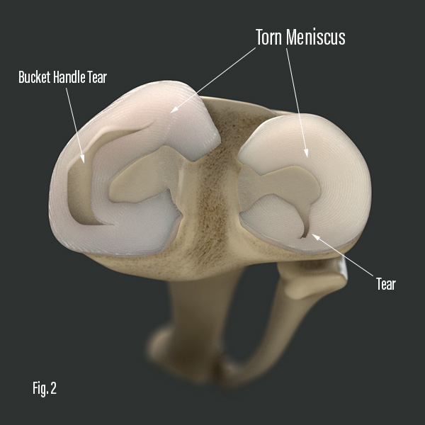 Knee Decompression Treats Meniscus Tears
